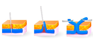 opération de phlébectomie